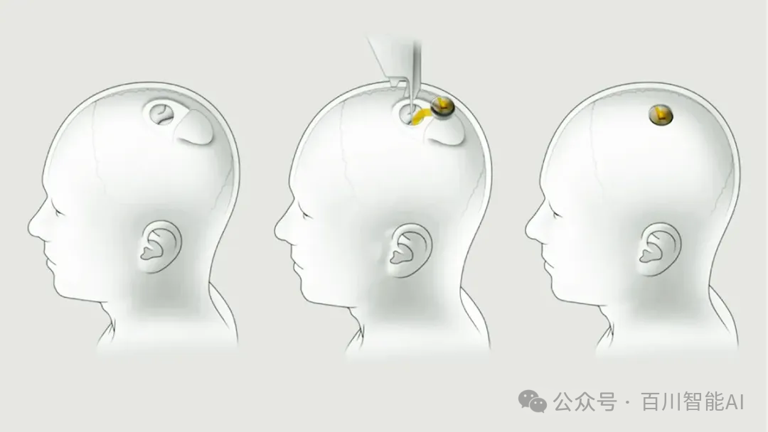 震惊！首个植入人体芯片发生故障！-AI.x社区